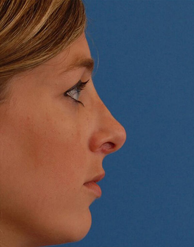 Patient Yr9mbNMlRKiHtXCC9TXlOA - Revision Rhinoplasty Before & After Photos