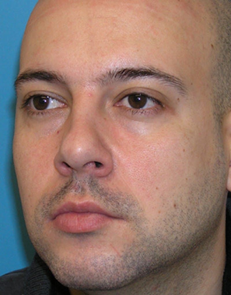 Rhinoplasty  Before & After Gallery - Patient 332665 - Image 3