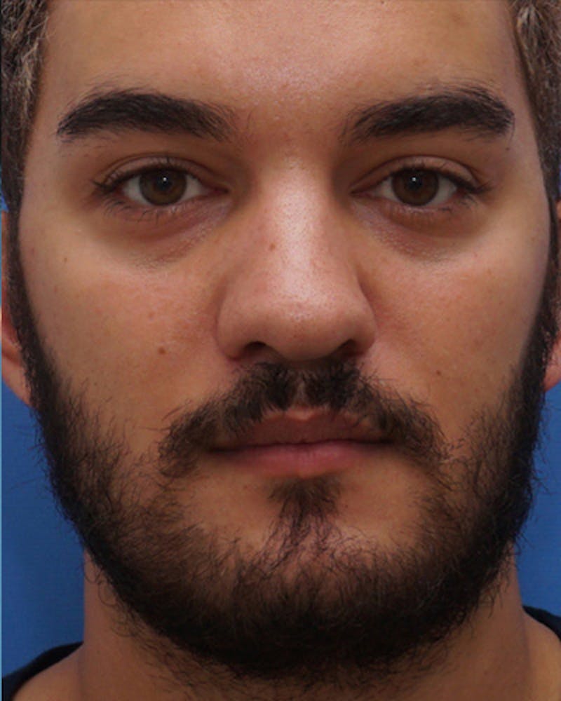 Rhinoplasty  Before & After Gallery - Patient 157415 - Image 3