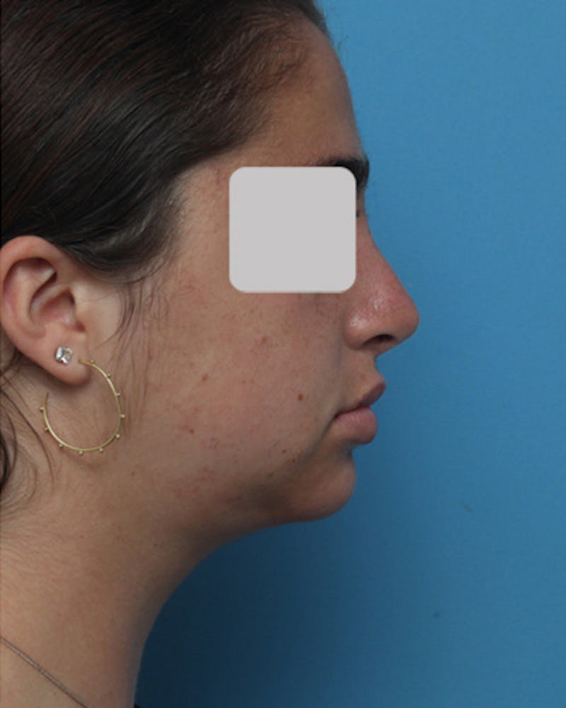 Rhinoplasty Before & After Gallery - Patient 347600 - Image 2