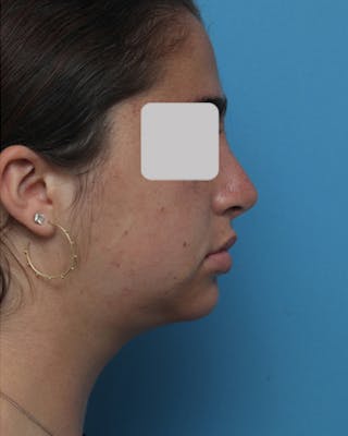 Rhinoplasty Before & After Gallery - Patient 199174 - Image 2