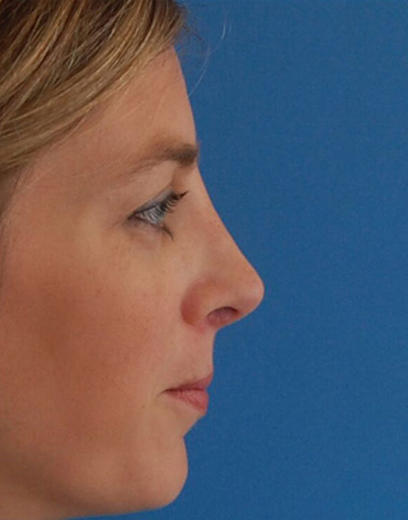 Revision Rhinoplasty Before & After Gallery - Patient 160126 - Image 2