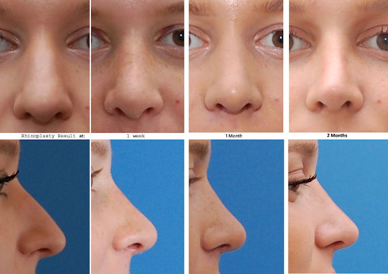 Rhinoplasty Healing Stages Before & After Gallery - Patient 165499 - Image 1