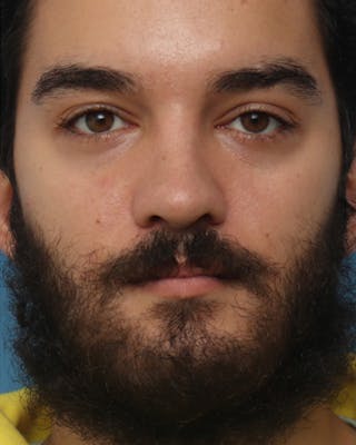 Favorite Male Rhinoplasty Before & After Gallery - Patient 236736 - Image 4