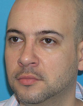 Rhinoplasty Before & After Gallery - Patient 332665 - Image 4