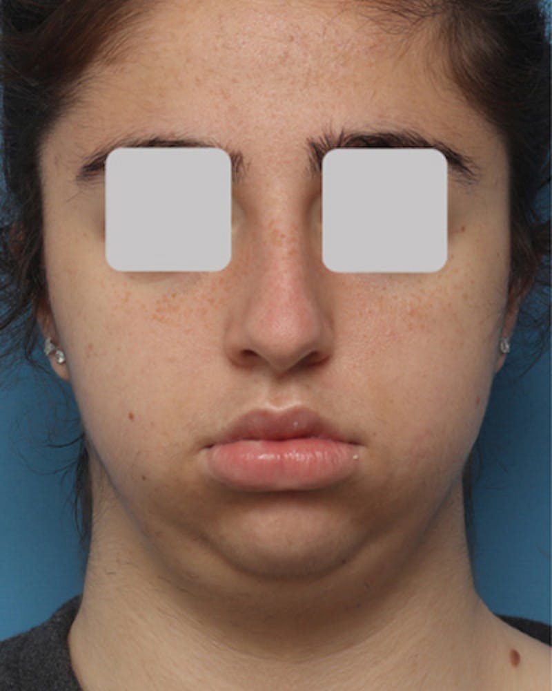Rhinoplasty Before & After Gallery - Patient 347600 - Image 3