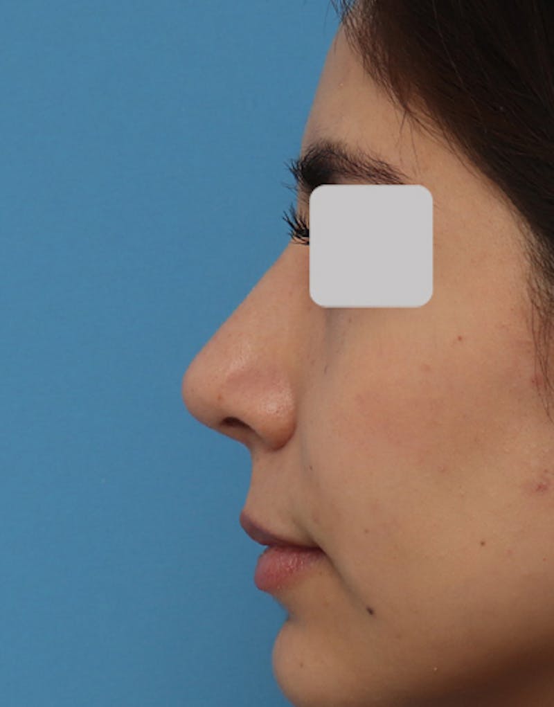 Ethnic Rhinoplasty Before & After Gallery - Patient 199833 - Image 2