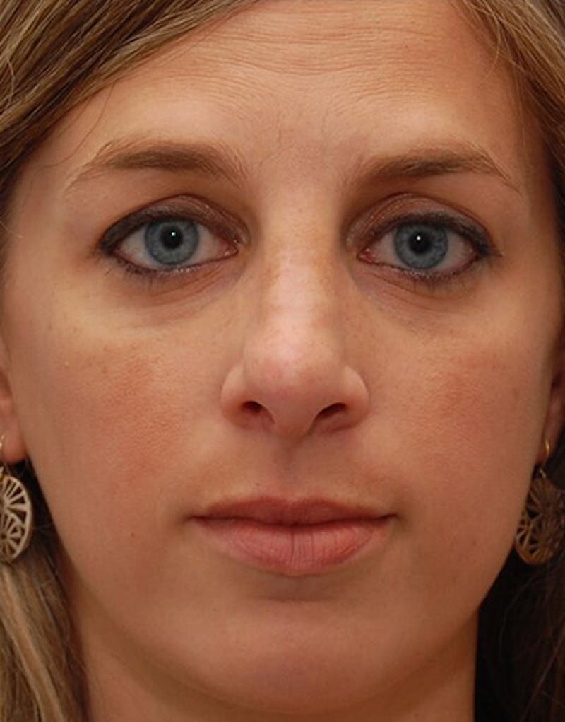 Rhinoplasty  Before & After Gallery - Patient 362241 - Image 3