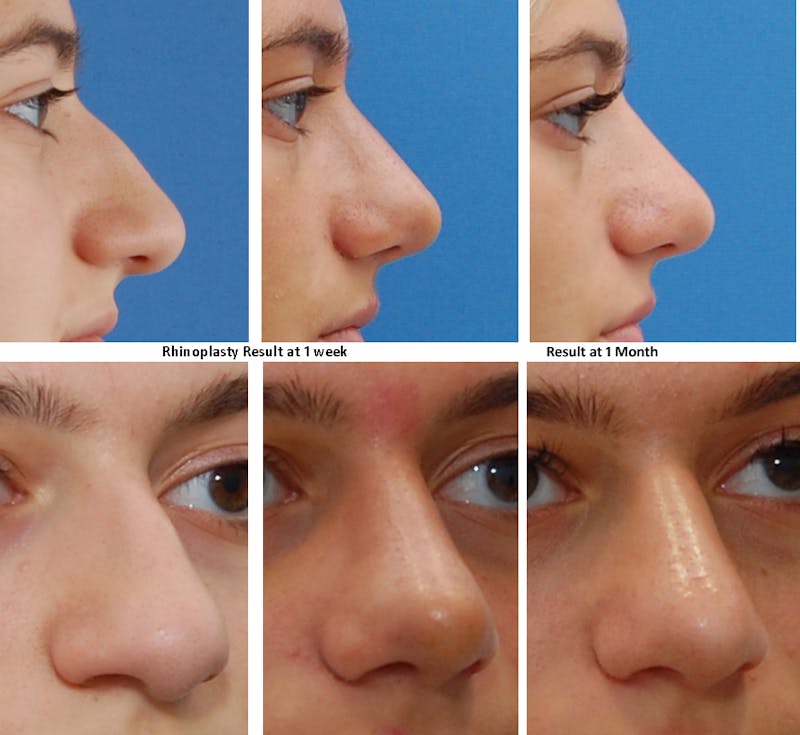 Rhinoplasty Healing Stages Before & After Gallery - Patient 364993 - Image 1