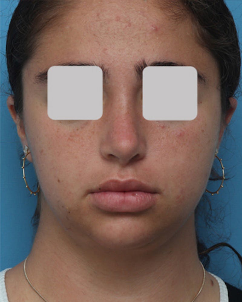 Rhinoplasty Before & After Gallery - Patient 347600 - Image 4