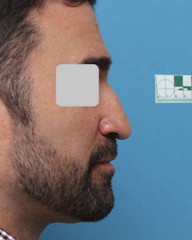 Male Rhinoplasty Before & After Gallery - Patient 207885 - Image 1