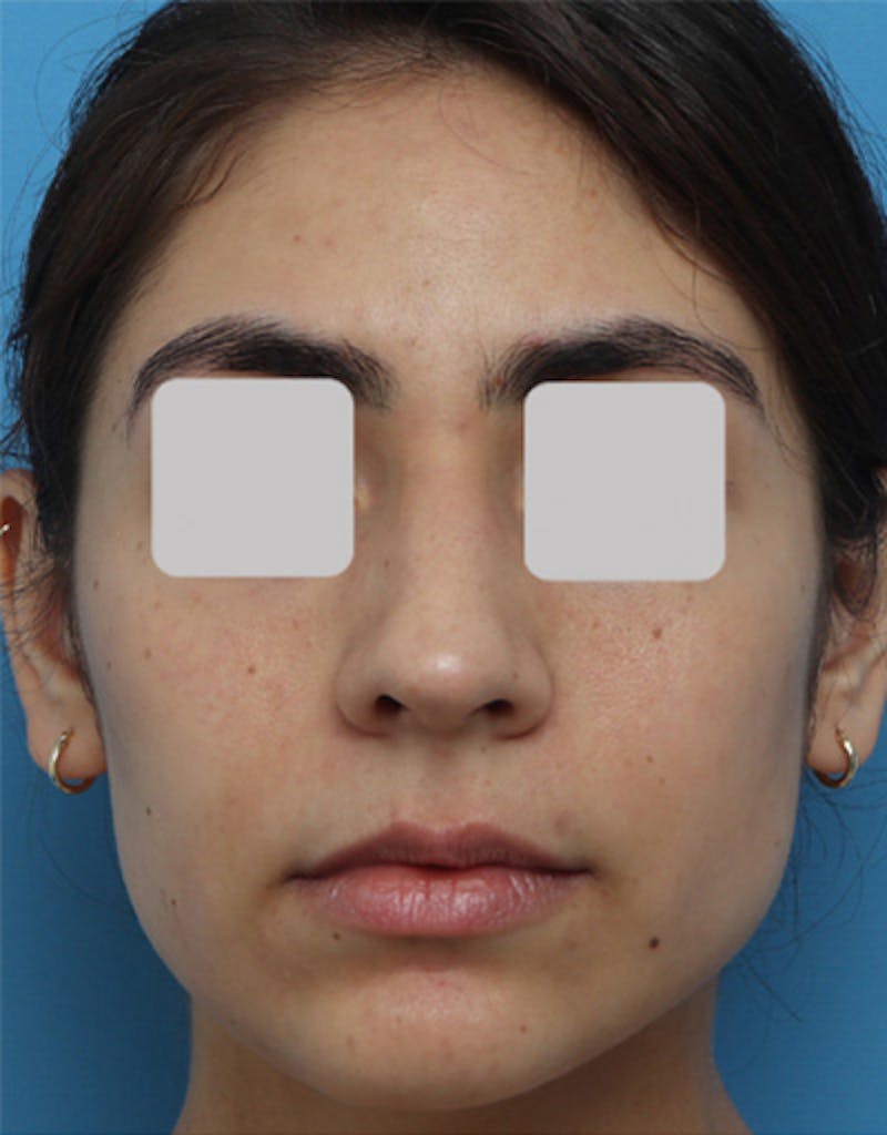 Ethnic Rhinoplasty Before & After Gallery - Patient 199833 - Image 3