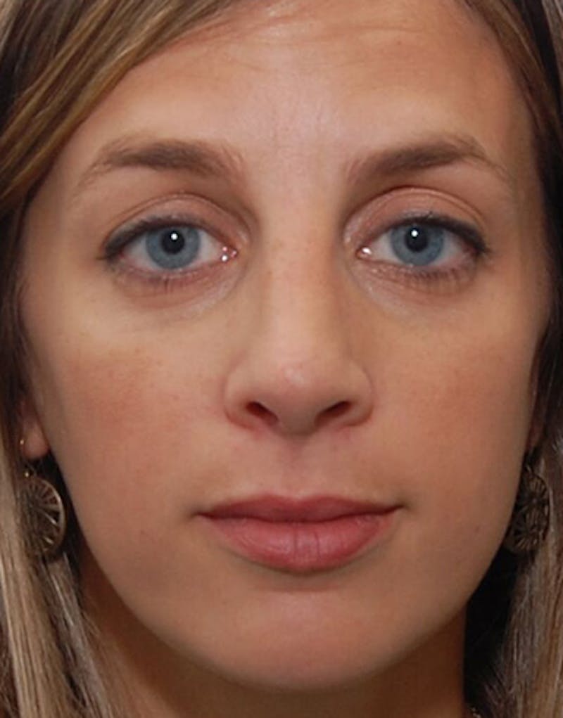 Revision Rhinoplasty Before & After Gallery - Patient 160126 - Image 4