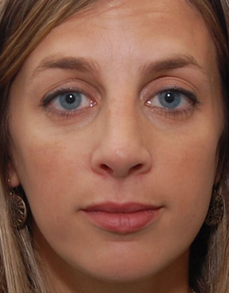 Rhinoplasty  Before & After Gallery - Patient 362241 - Image 4