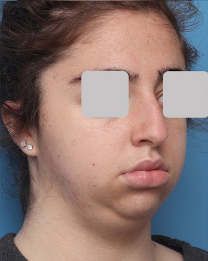 Rhinoplasty Before & After Gallery - Patient 347600 - Image 5