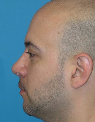 Rhinoplasty Before & After Gallery - Patient 332665 - Image 6