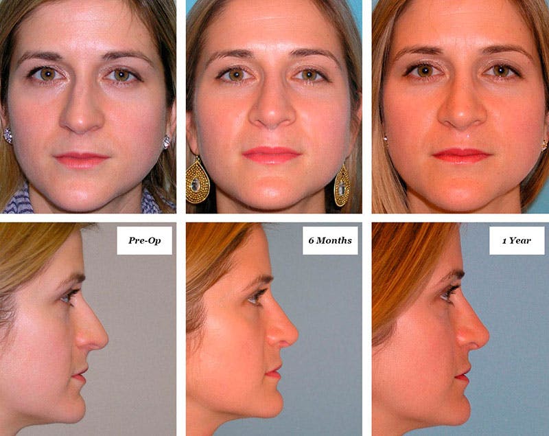 Rhinoplasty Healing Stages Before & After Gallery - Patient 187655 - Image 1