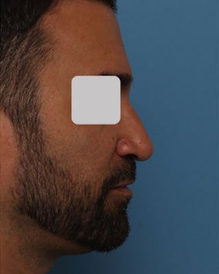 Rhinoplasty Before & After Gallery - Patient 161992 - Image 2