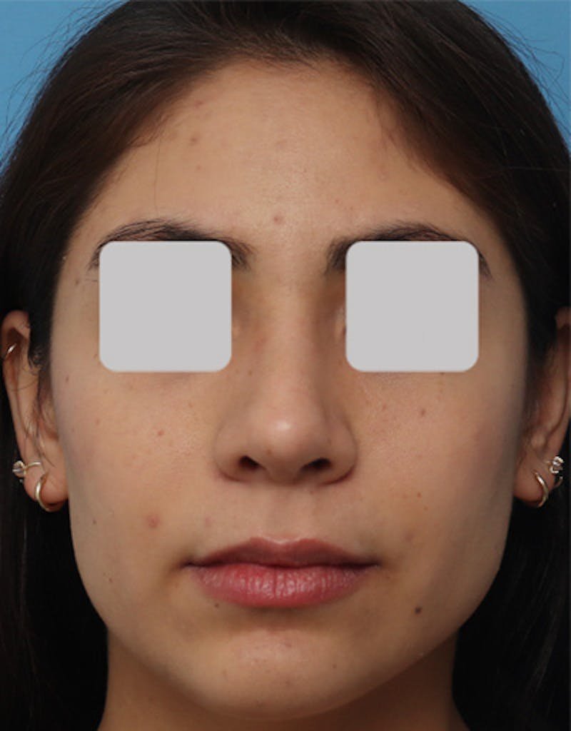 Ethnic Rhinoplasty Before & After Gallery - Patient 199833 - Image 4