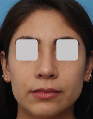 Rhinoplasty Before & After Gallery - Patient 271859 - Image 4