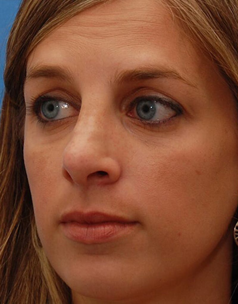 Revision Rhinoplasty Before & After Gallery - Patient 160126 - Image 5