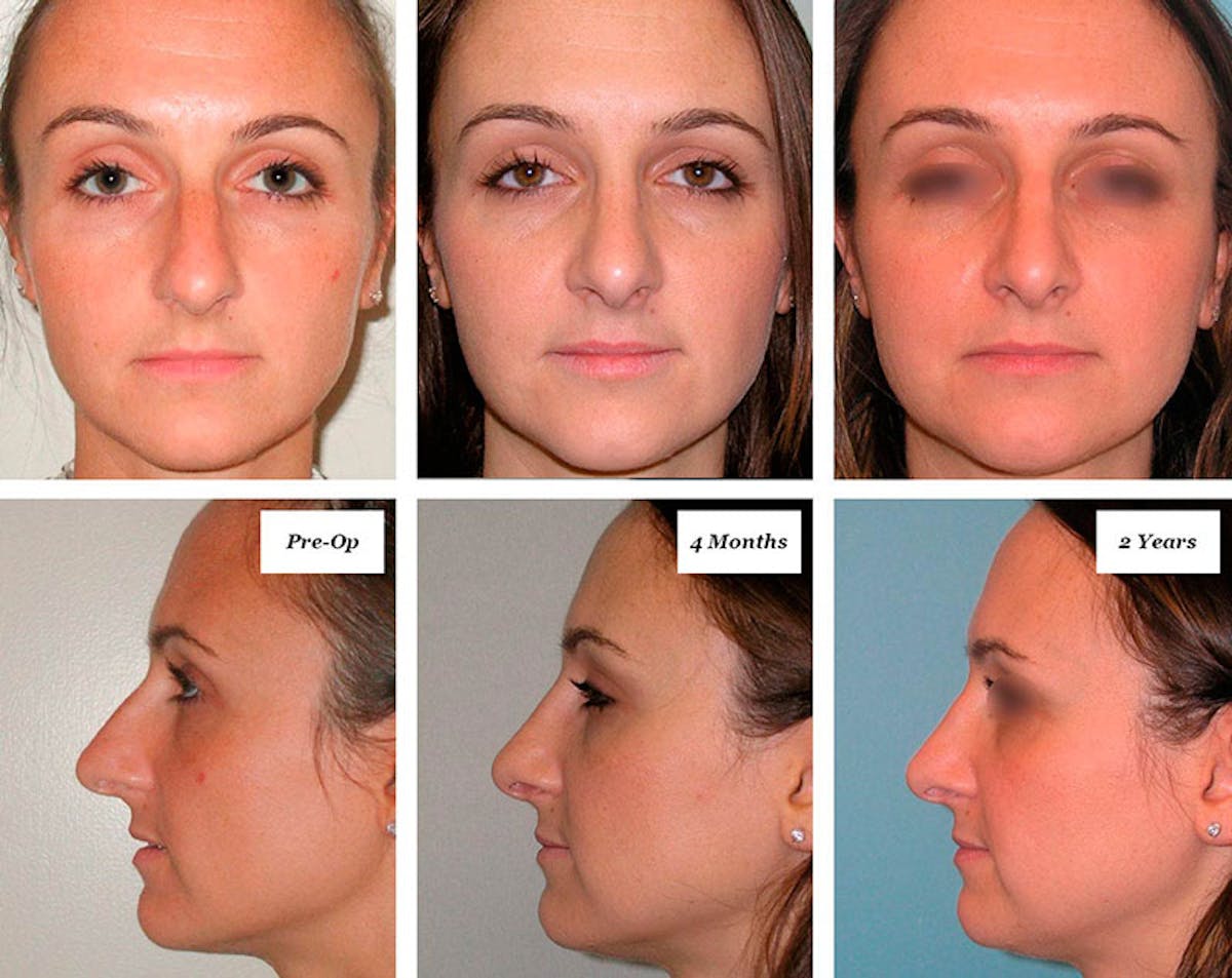 Rhinoplasty Healing Stages Before & After Gallery - Patient 260509 - Image 1
