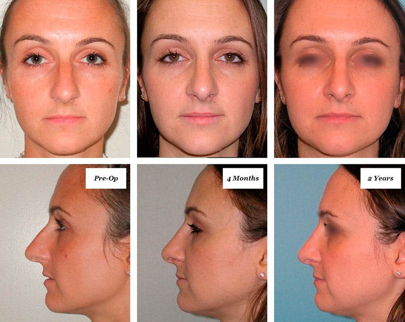 Rhinoplasty Healing Stages Before & After Gallery - Patient 260509 - Image 1