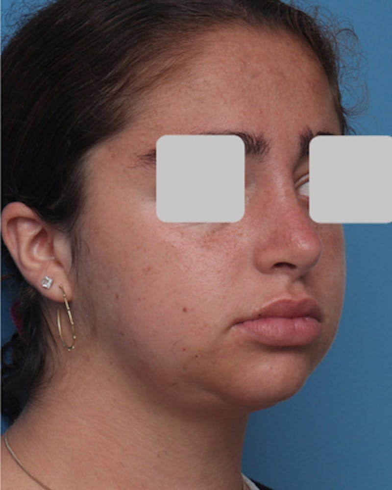 Rhinoplasty Before & After Gallery - Patient 347600 - Image 6