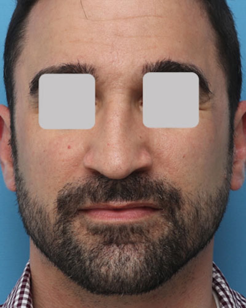 Rhinoplasty  Before & After Gallery - Patient 161992 - Image 3