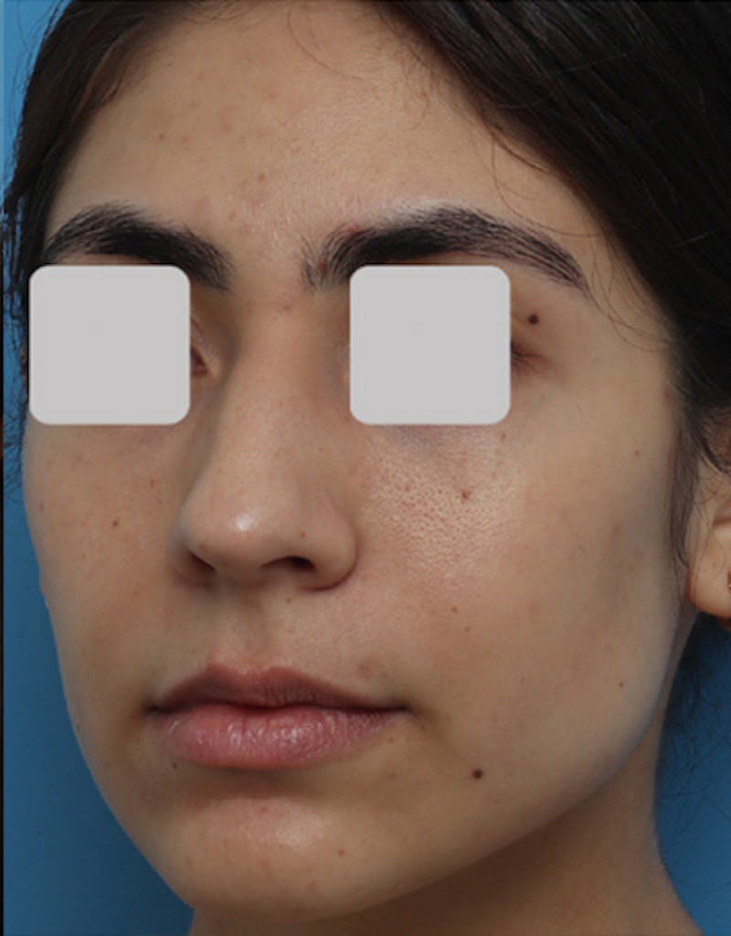 Ethnic Rhinoplasty Before & After Gallery - Patient 199833 - Image 5