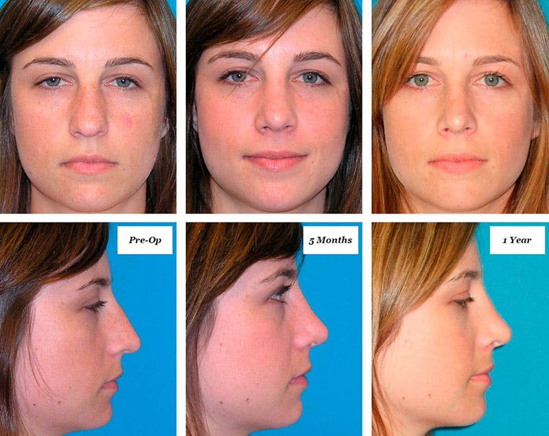 Rhinoplasty Healing Stages Before & After Gallery - Patient 216272 - Image 1