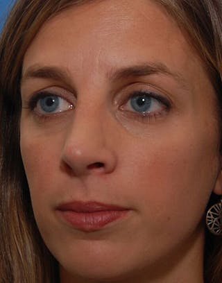 Rhinoplasty Before & After Gallery - Patient 362241 - Image 6