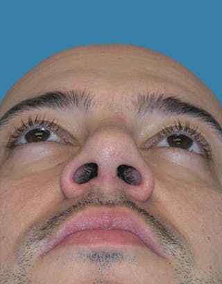 Rhinoplasty Before & After Gallery - Patient 332665 - Image 8