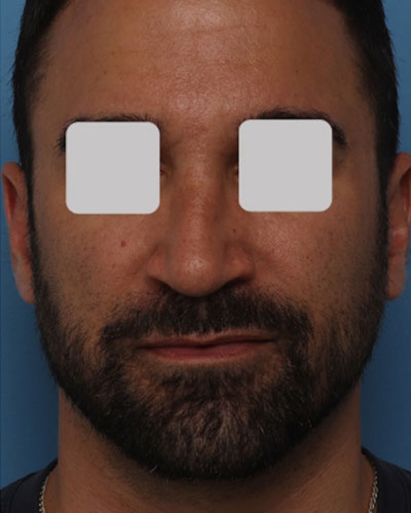 Male Rhinoplasty Before & After Gallery - Patient 207885 - Image 4