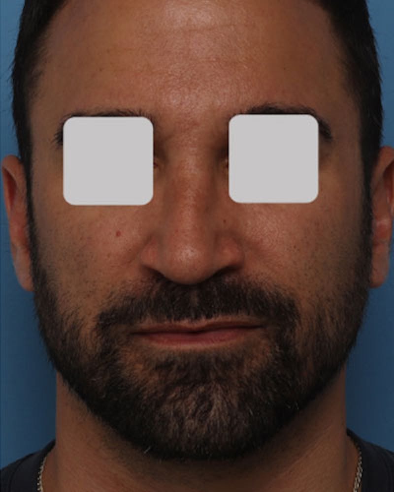 Rhinoplasty  Before & After Gallery - Patient 161992 - Image 4