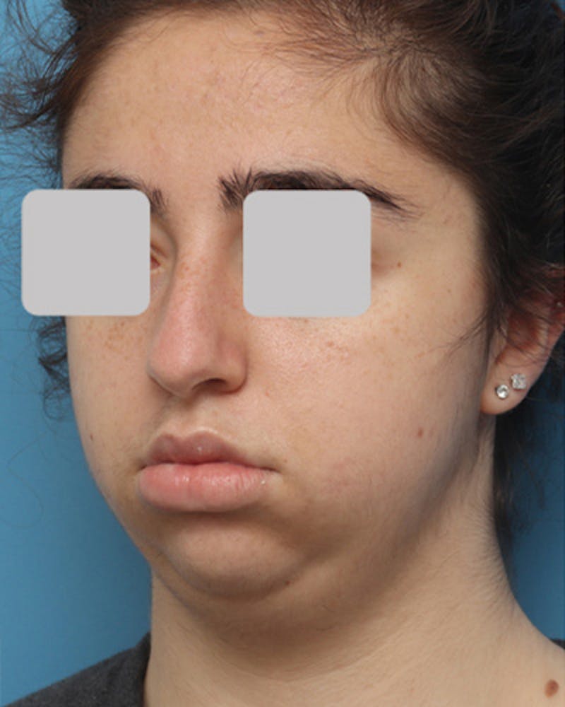 Rhinoplasty Before & After Gallery - Patient 347600 - Image 7