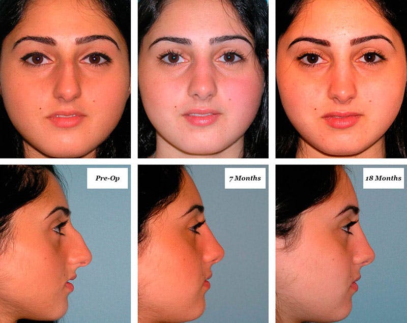Rhinoplasty Healing Stages Before & After Gallery - Patient 123675 - Image 1