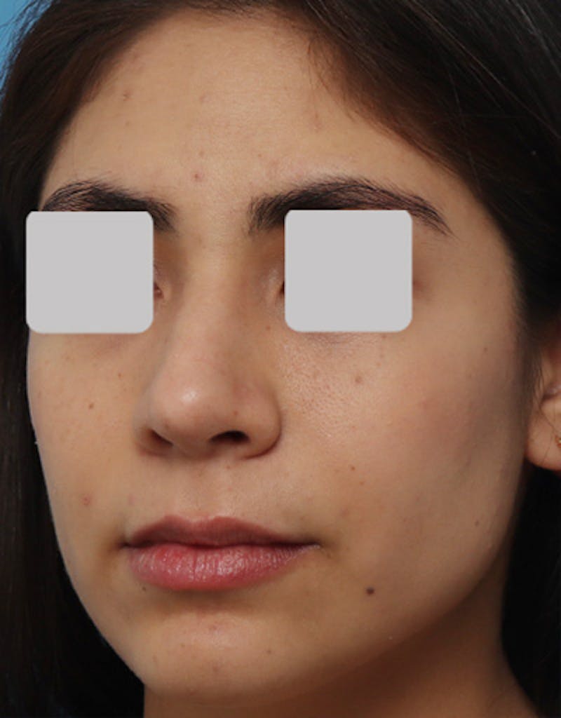 Ethnic Rhinoplasty Before & After Gallery - Patient 199833 - Image 6