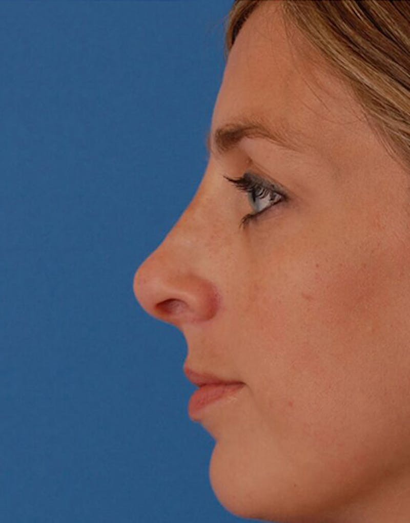 Revision Rhinoplasty Before & After Gallery - Patient 160126 - Image 7