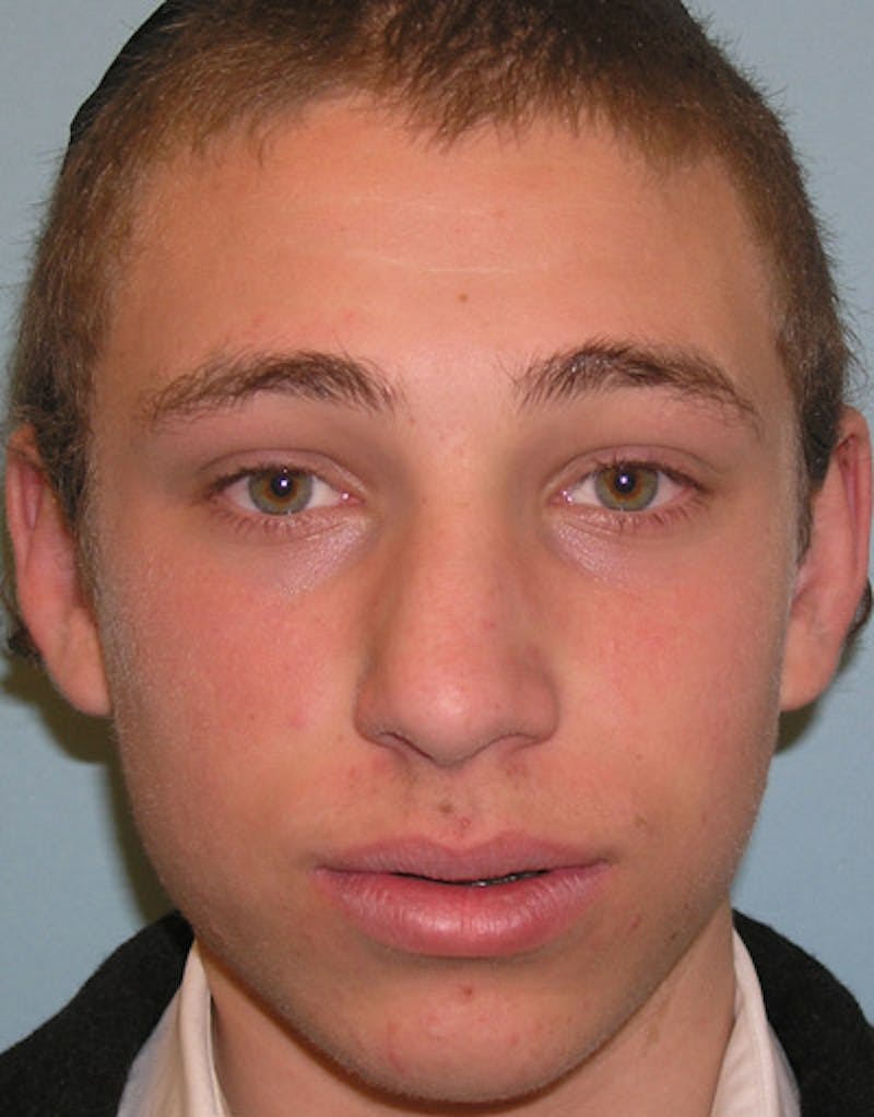 Patient elrqdD6MSMeP0-hyYzm7oA - Foundation Rhinoplasty Before & After Photos