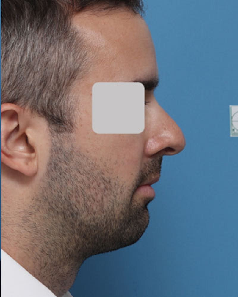 Patient VajyWwVwSR6NhBeiZsipAA - Male Rhinoplasty Before & After Photos