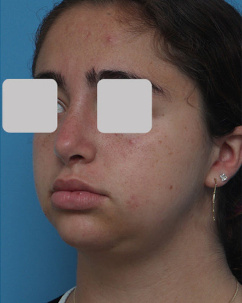 Rhinoplasty Before & After Gallery - Patient 347600 - Image 8