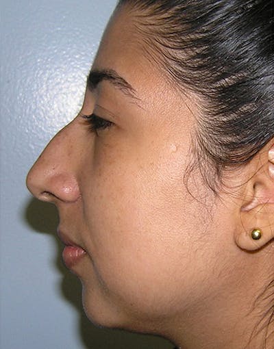 Rhinoplasty Before & After Gallery - Patient 435456 - Image 1