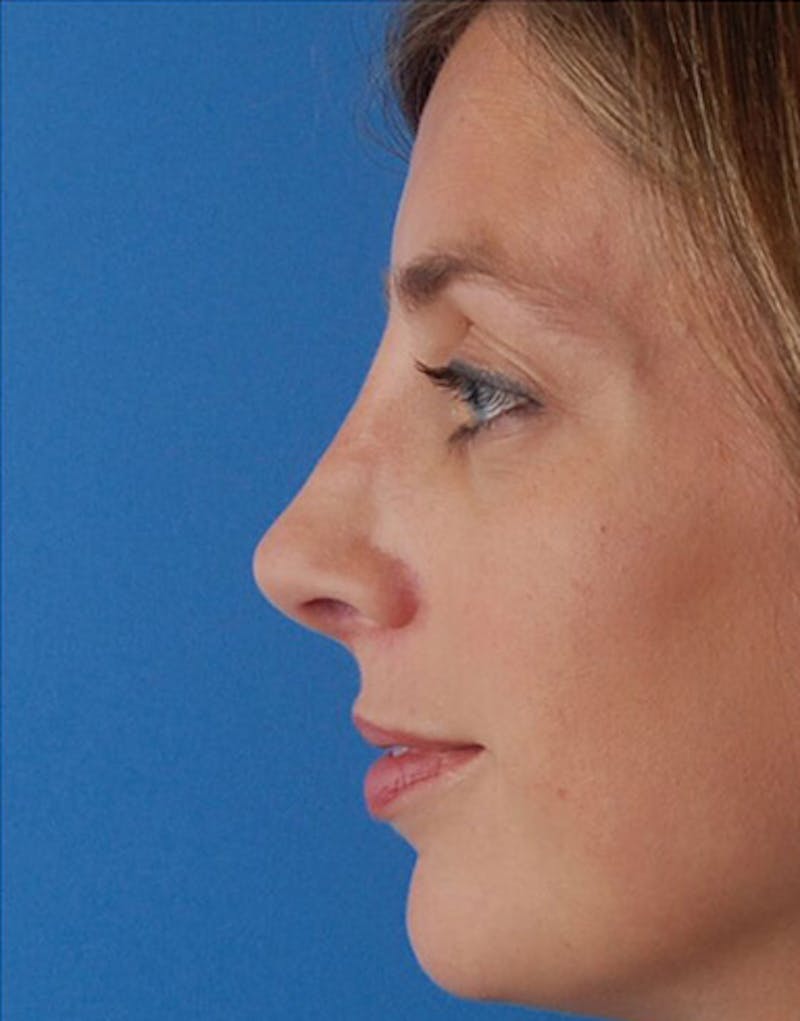 Revision Rhinoplasty Before & After Gallery - Patient 160126 - Image 8