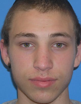 Rhinoplasty Before & After Gallery - Patient 245160 - Image 2