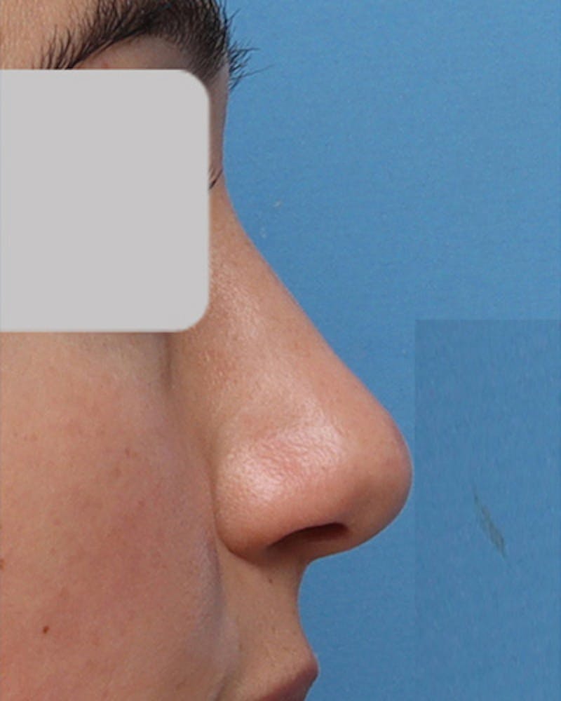 Rhinoplasty Before & After Gallery - Patient 237131 - Image 1