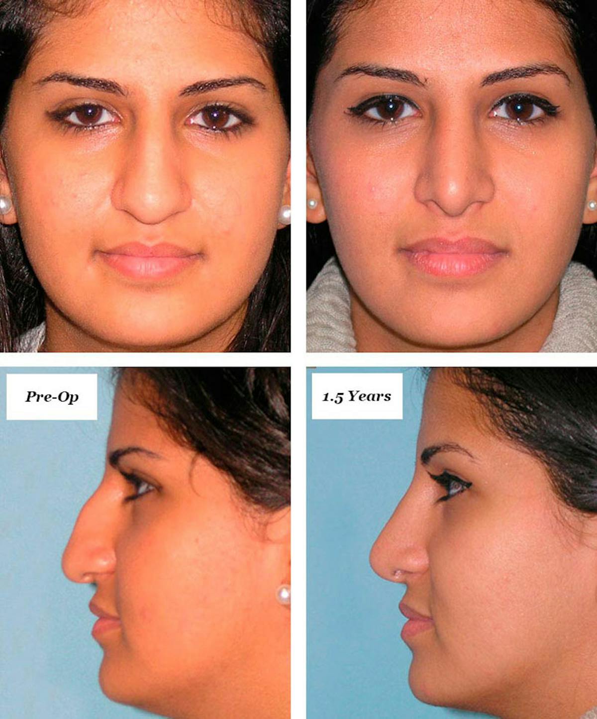 Rhinoplasty Healing Stages Before & After Gallery - Patient 183446 - Image 1