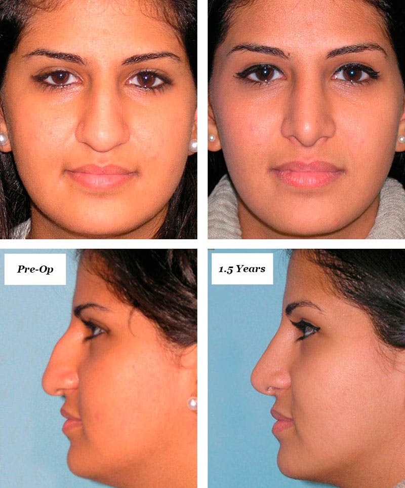 Rhinoplasty Healing Stages Before & After Gallery - Patient 183446 - Image 1