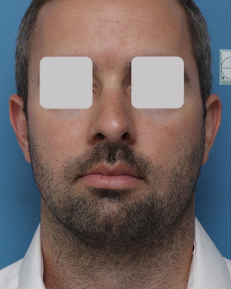 Male Rhinoplasty Before & After Gallery - Patient 202741 - Image 3