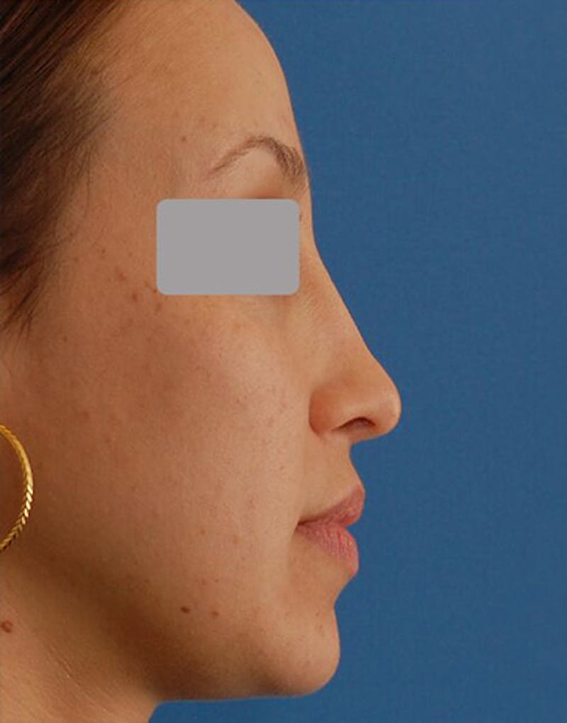 Revision Rhinoplasty Before & After Gallery - Patient 279777 - Image 1